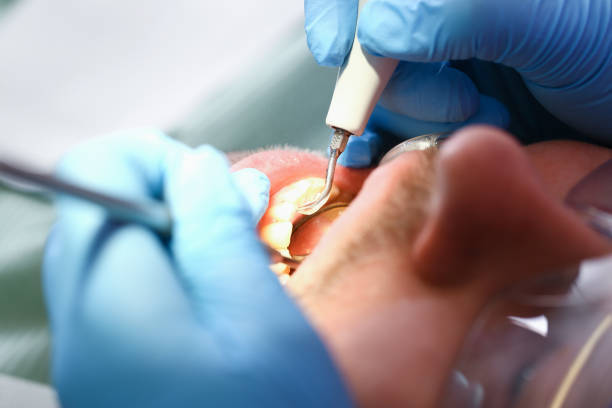 Best Emergency Dental Care for Abscessed Tooth in New London, CT